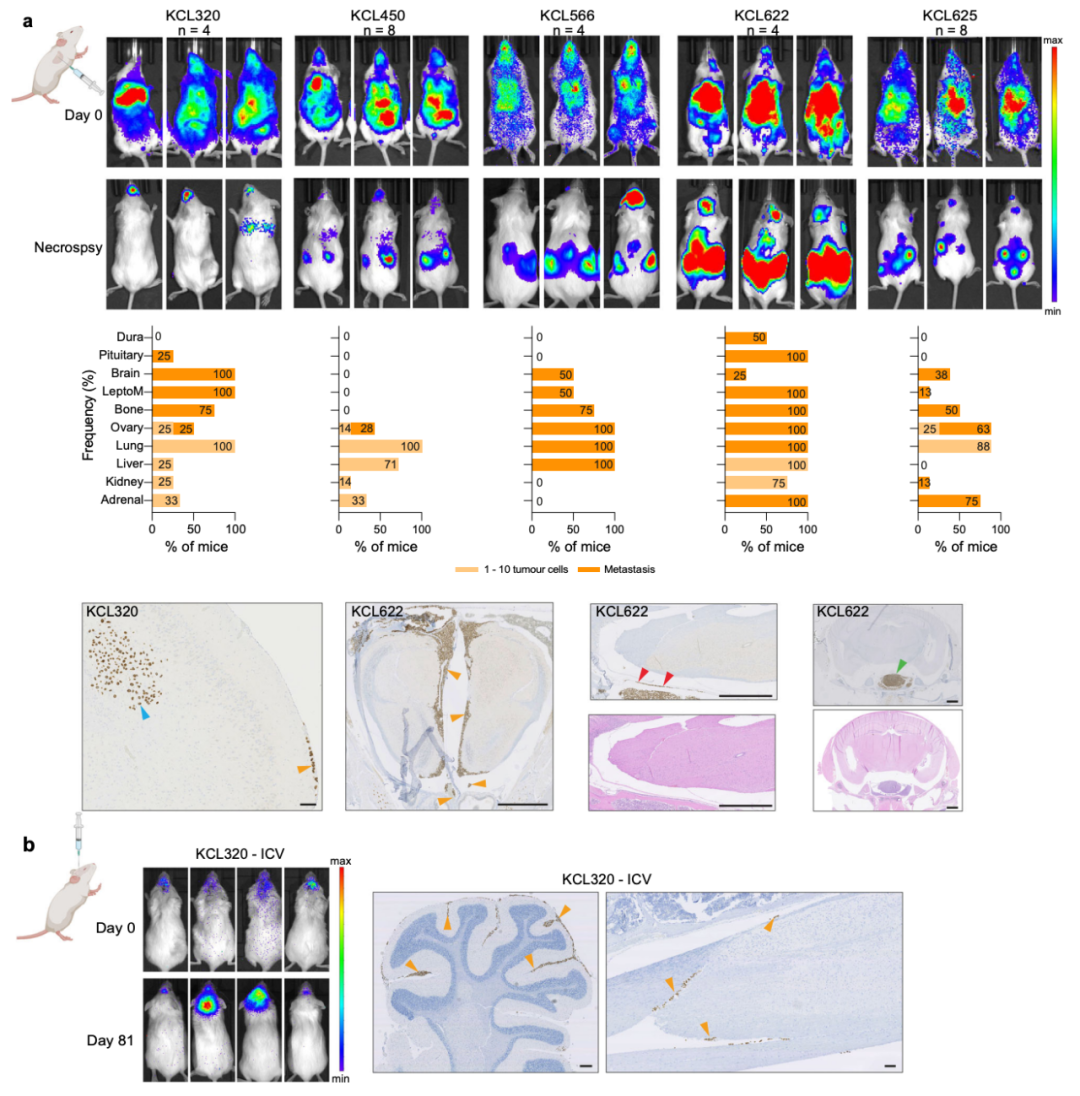 Nature子刊：患者來源的類器官，為乳腺癌腦轉移帶來新見解